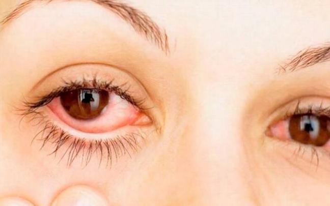 Es la infecci&oacute;n ocular m&aacute;s frecuente entre los ni&ntilde;os y ni&ntilde;as y muy contagiosa.