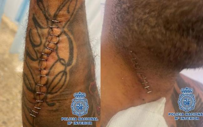 La herida en el antebrazo y en el cuello de la víctima, que ha logrado sobrevivir. La herida en el antebrazo y en el cuello de la víctima, que ha logrado sobrevivir.