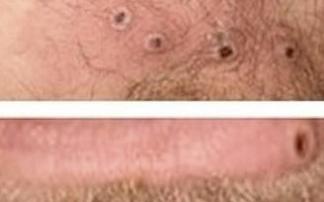 Sintomatología externa de la viruela del mono. Foto: E.P.