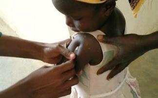 Una niña en un centro de salud de Mozambique recibe una inyección de la vacuna contra la malaria Una niña en un centro de salud de Mozambique recibe una inyección de la vacuna contra la malaria