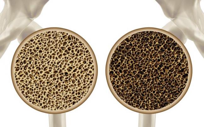 Ejemplo de la afección a los huesos provocada por la osteoporosis. Ejemplo de la afección a los huesos provocada por la osteoporosis.