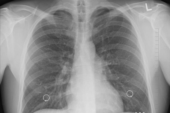 Sanidad estudia implantar programas de cribado de cáncer de pulmón