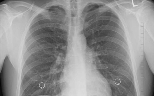 Sanidad estudia implantar programas de cribado de cáncer de pulmón Sanidad estudia implantar programas de cribado de cáncer de pulmón