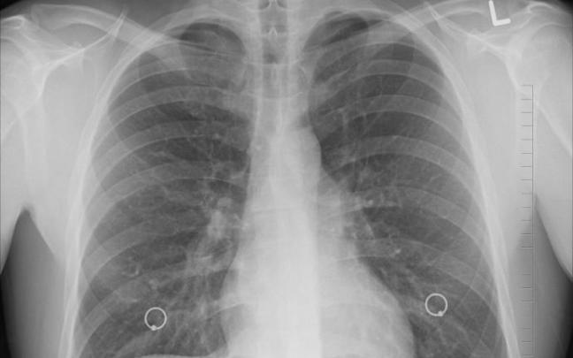 Un estudio aclara el origen del cáncer de pulmón en los no fumadores Un estudio aclara el origen del cáncer de pulmón en los no fumadores