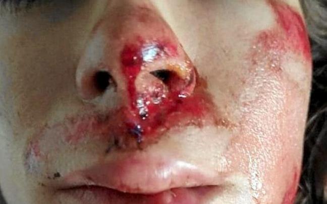 La propia ciclista difundió esta imagen, con los puntos en su rostro.