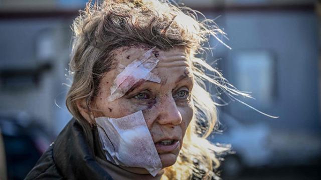 Una mujer con heridas causadas por un bombardeo en la ciudad ucraniana de Chuguiv.