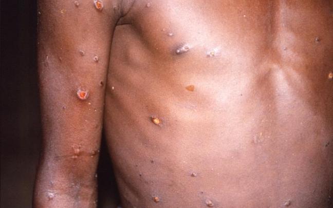 Lesiones en la piel provocadas por la viruela del mono.